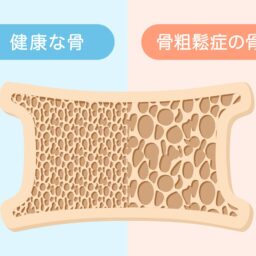 【60代ヘルスケア】健康な骨と骨粗しょう症の骨の比較