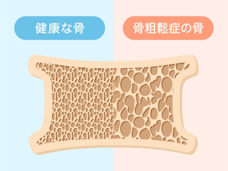 【60代ヘルスケア】健康な骨と骨粗しょう症の骨の比較