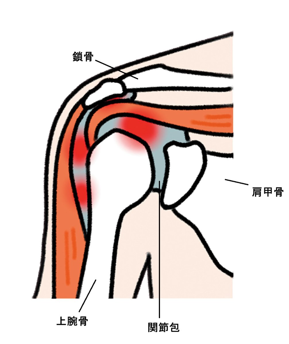 六十肩とは