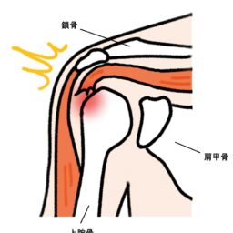 腱板断裂
