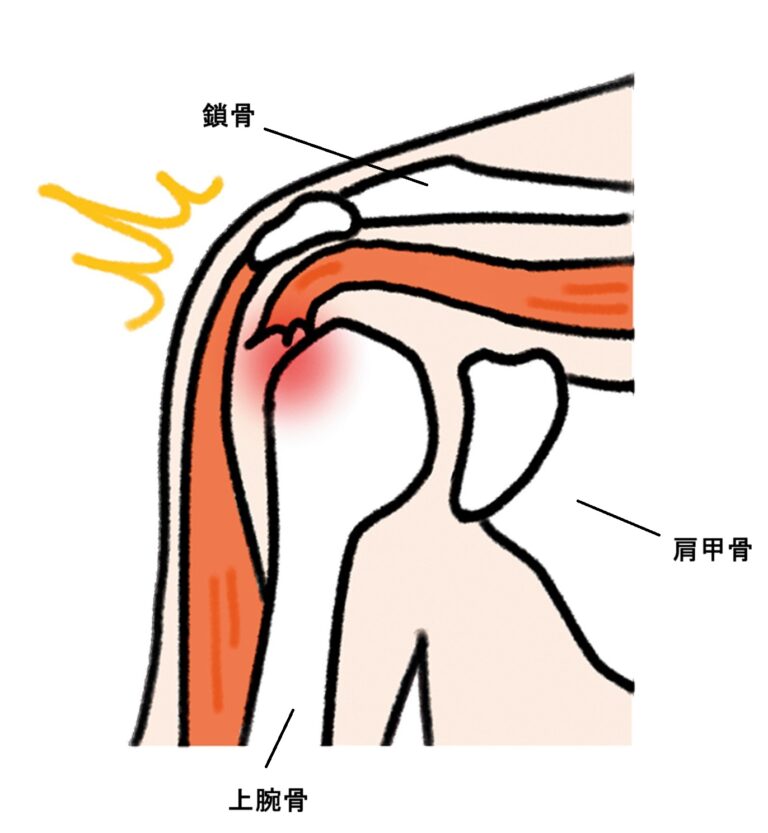 腱板断裂