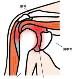 癒着性肩関節包炎