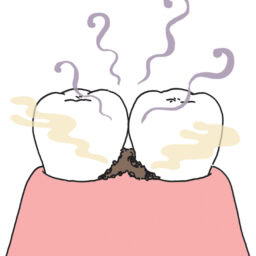 むし歯、歯周病