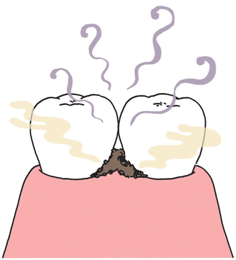 むし歯、歯周病