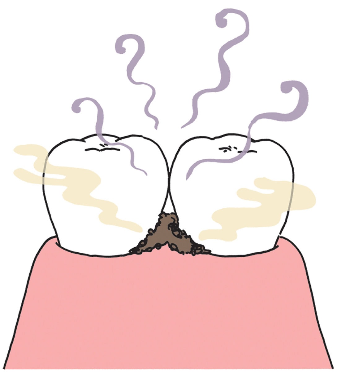 むし歯、歯周病