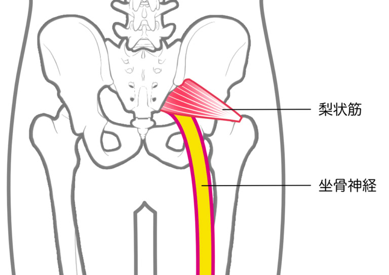 坐骨神経痛とは?