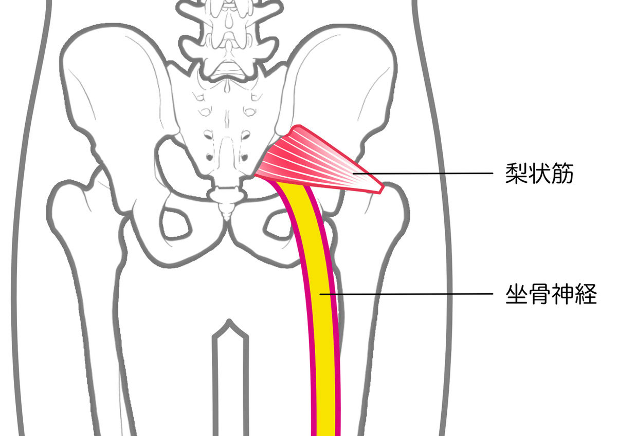 坐骨神経痛とは？