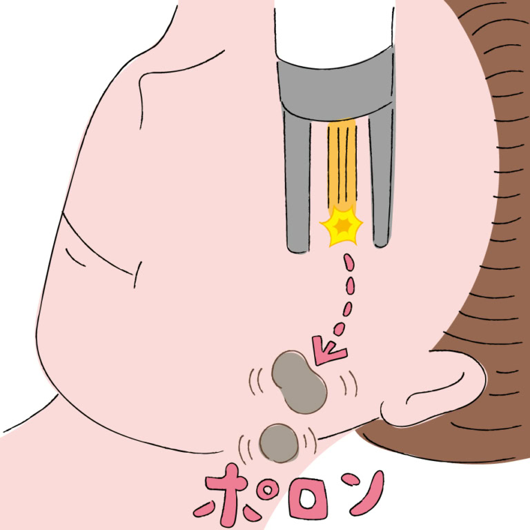 レーザー後こそ、日々の美白ケアが不可欠です