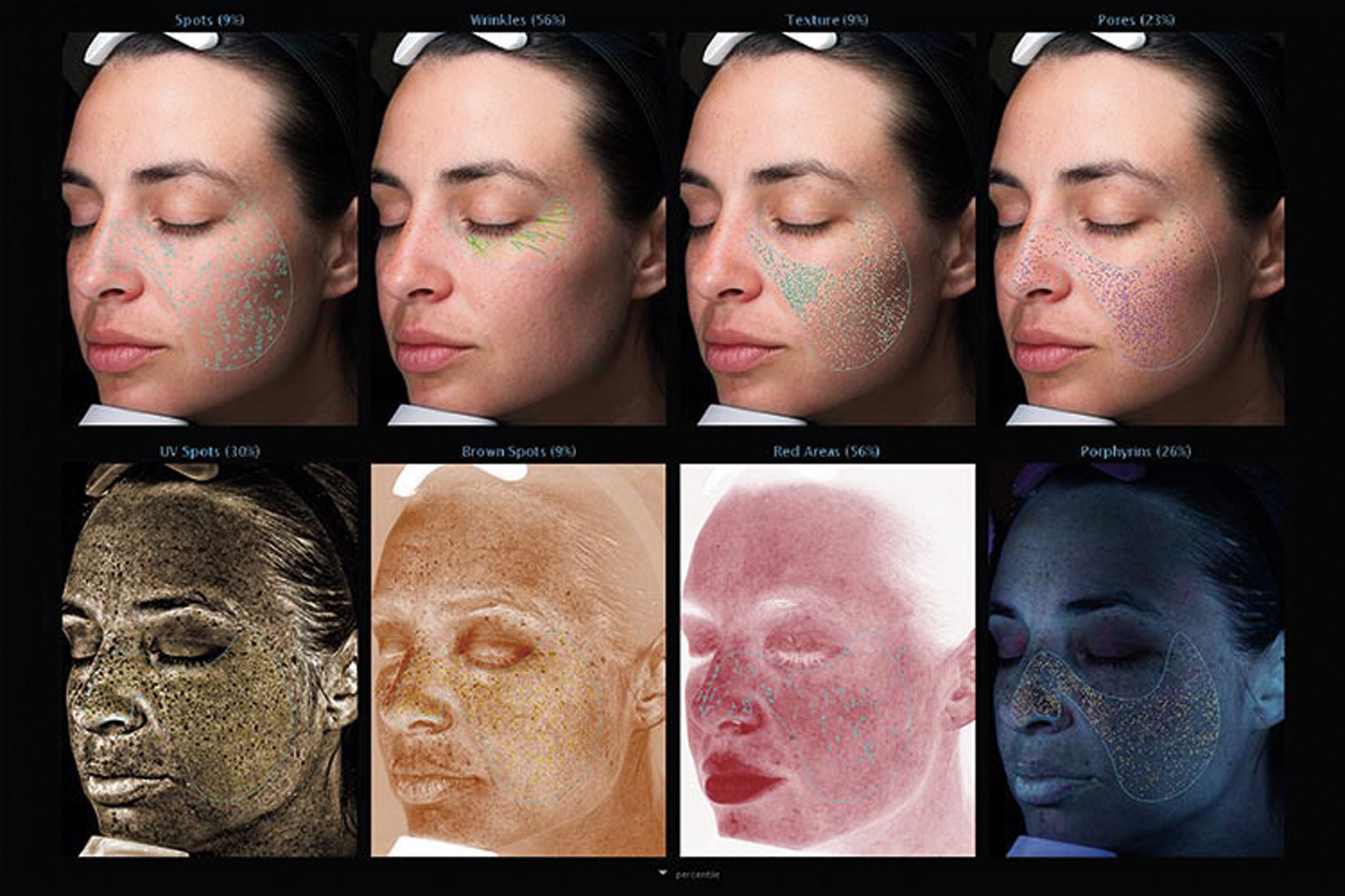 VISIAでシミ予備軍をチェック