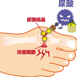 痛風とは？