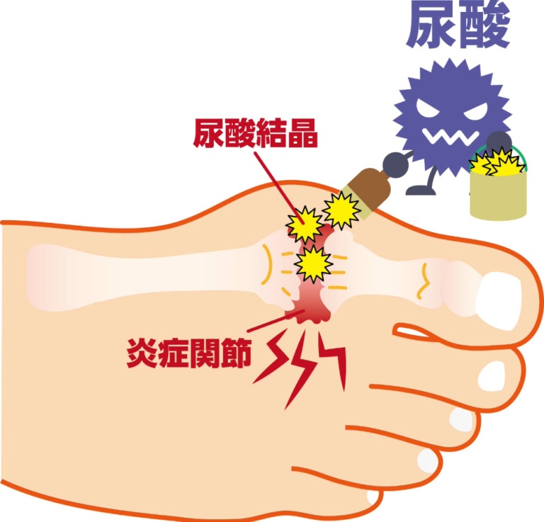 痛風とは?